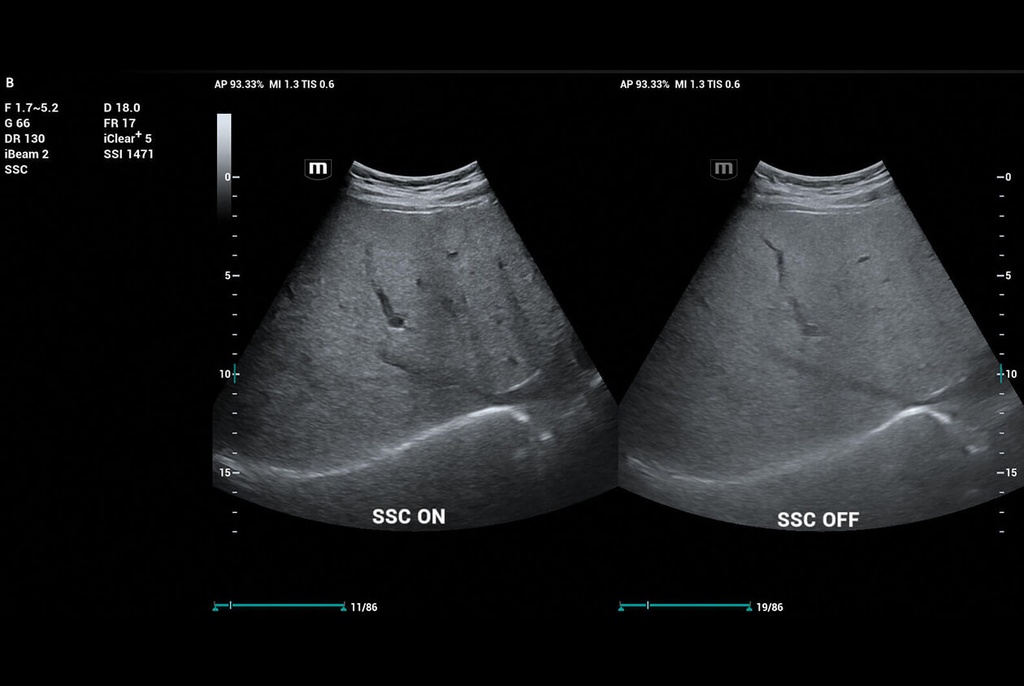 SSC (Sound Speed Compensation), Focus Free, HD Scope
