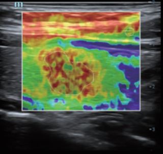 Natural Touch Elastography - Софтуер за ехограф Mindray