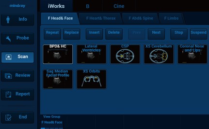 iWorks™ (Standardized Workflow Protocol) - Софтуер за ехограф Mindray