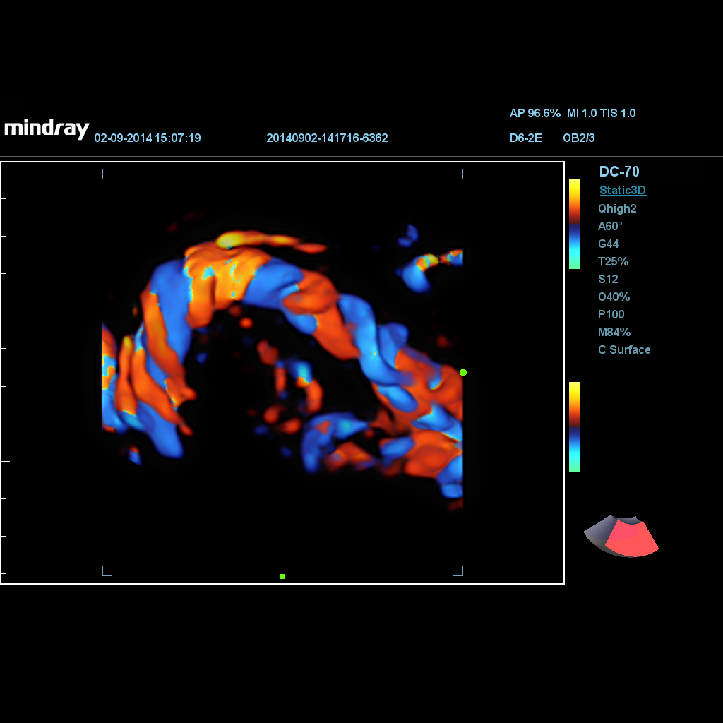 Color 3D - Софтуер за ехограф Mindray