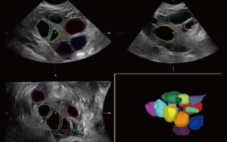 Smart FLC™ - Софтуер за ехограф Mindray