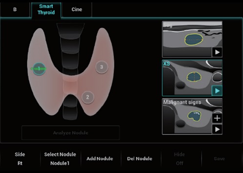 Smart Thyroid - Софтуер за ехограф Mindray