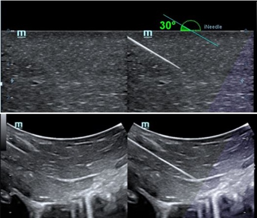 [119061667] iNeedle™ - Софтуер за ехограф Mindray